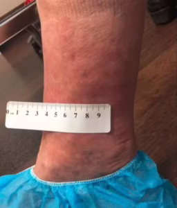 116147 Spider Vein Patient 9 after