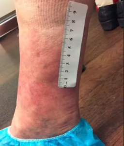 Patient 10 after left